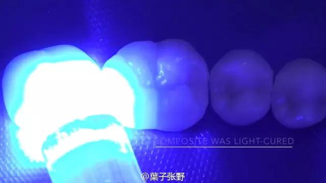 补牙疼吗补牙过程图,补牙全部过程是什么样子的