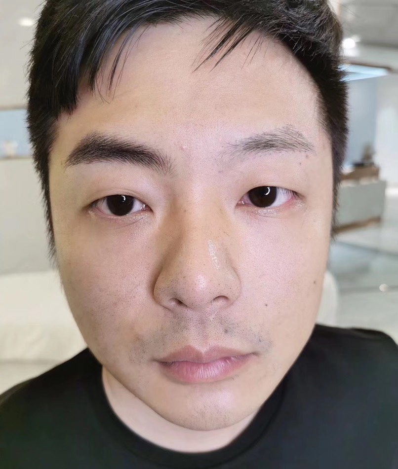 男生纹眉纹毁了怎么办,男生纹眉后太明显怎么办