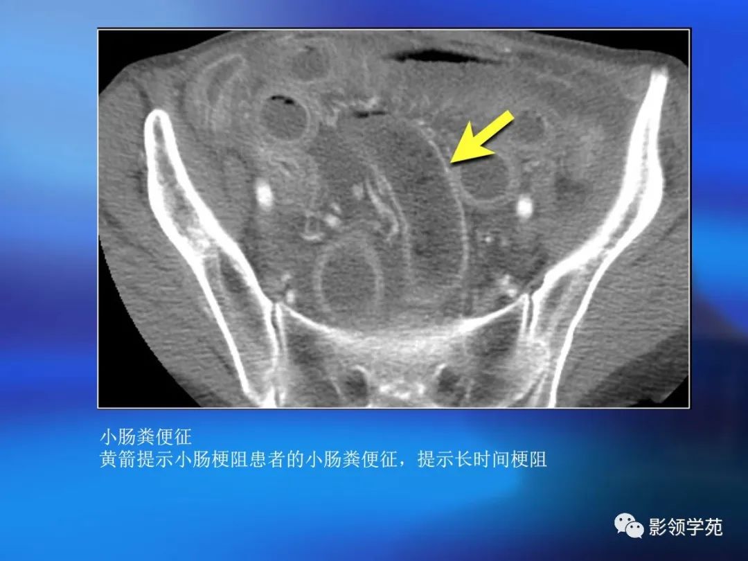 肠道内壁增厚,肠道扩张ct表现