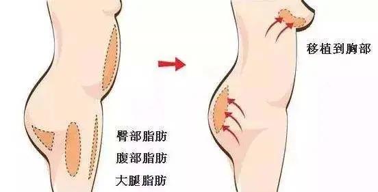 「知识分享」自体脂肪隆胸技术