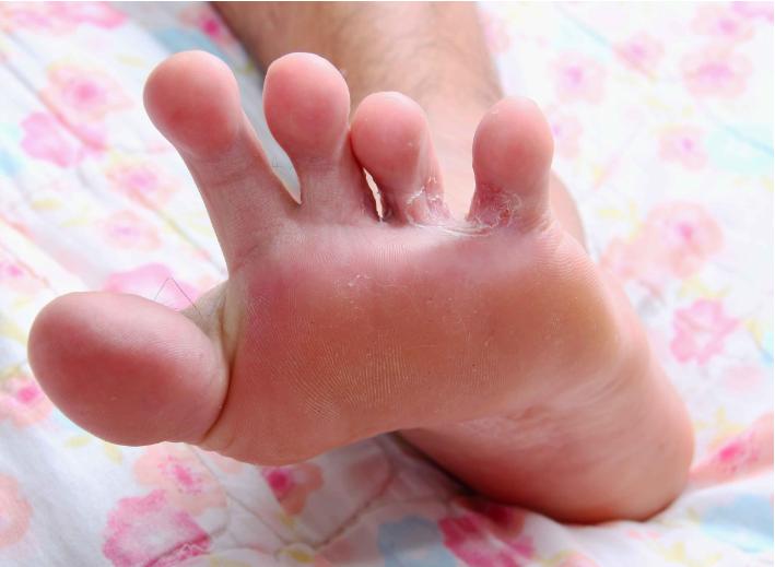 脚气不治后果,脚气不治咋样