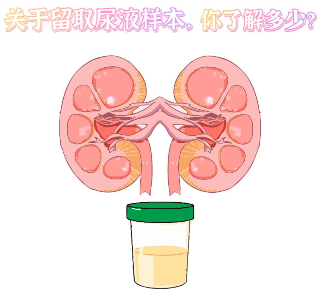 做尿检，不得不说的注意事项