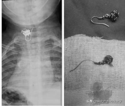 大人误食耳钉会自动排出吗,小孩误吞耳环已经到胃里如何处理