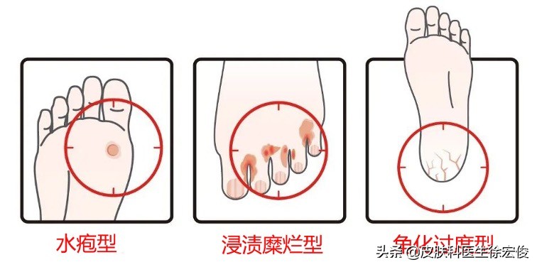 治疗脚气的方法让你告别脚气困扰,脚气治疗有妙招再也不尴尬了