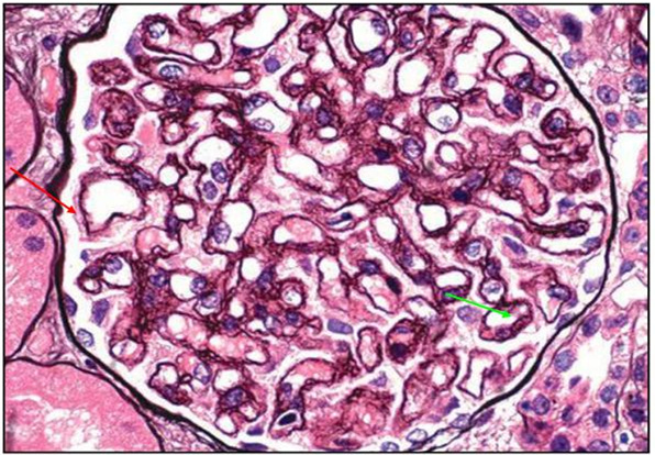 有肾炎抗核抗体阳性,得了肾炎必须做肾穿刺检查吗