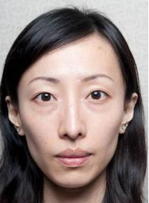 国字脸打瘦脸针有什么副作用吗,打瘦脸针有没有副作用和后遗症