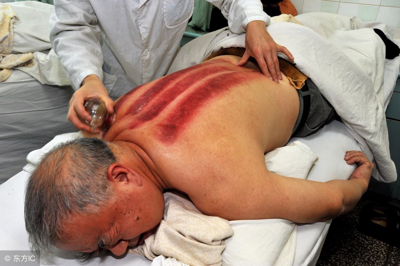 阿娇晒伤痕照称即将愈合,阿娇背部刮痧图片