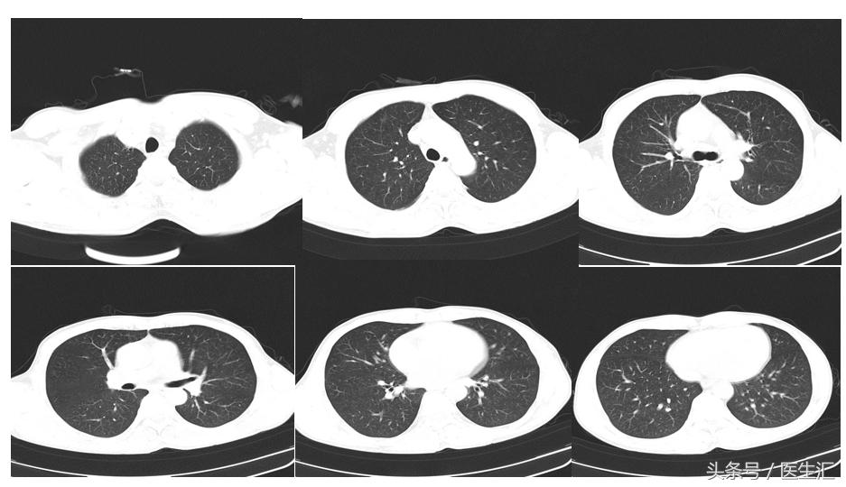 不小心吸入水泥粉末怎么办,吸入水泥粉末怎么办