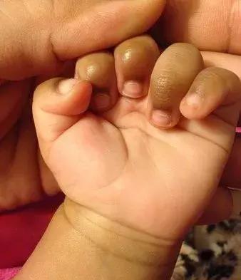 手指皮肤发黑是什么原因,手指关节处皮肤发黑发皱