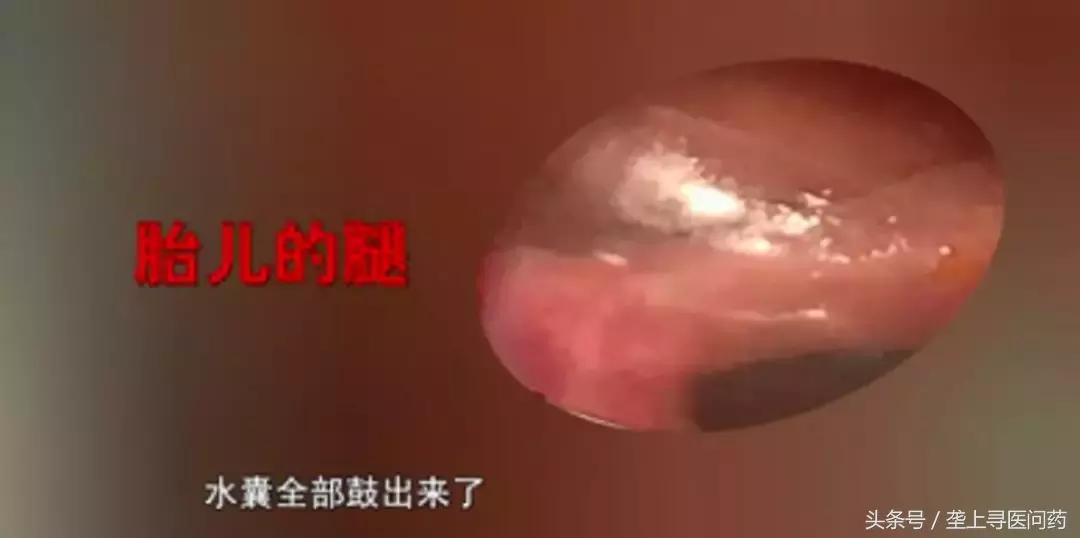 怀孕13周孩子会自然掉出来吗,孕中期觉得孩子要掉出来