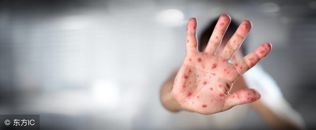 小孩子手足口病发烧怎么办,儿童手足口病发热怎么办