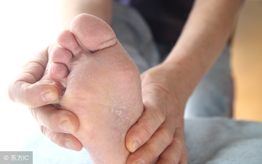 比金达克宁效果更好的抗真菌药膏,比达克宁好的抗真菌药是什么