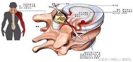 神经根型颈椎病保守治疗方法,颈椎病保守治疗有效吗