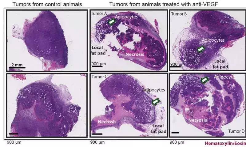 抗癌最新突破新药,宫颈癌免疫治疗加靶向治疗效果