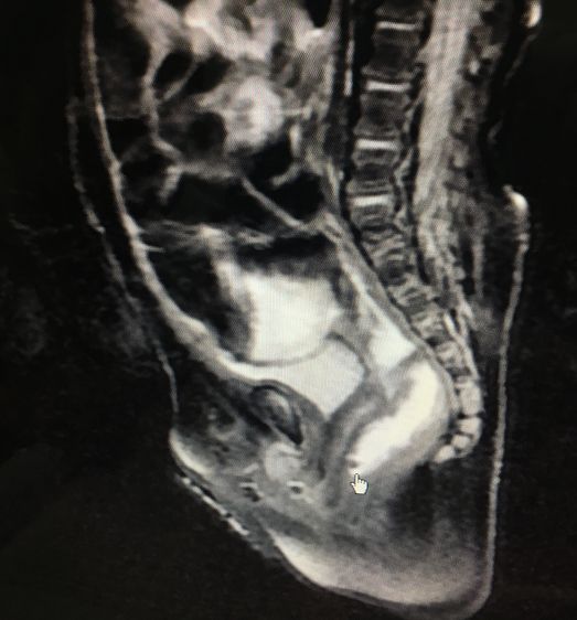 东莞男婴生下来没有肛门!愁坏了父母,憋坏了孩子……医生……