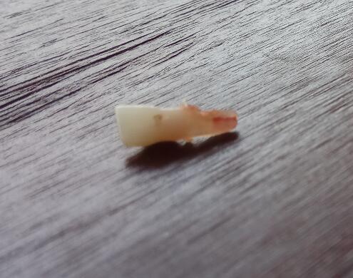 小孩乳牙没掉长出恒牙需要拔掉吗,孩子乳牙拔掉恒牙没长出来怎么办