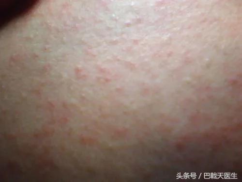 孩子出疹子宝妈需要忌口哪些,宝妈身上起疹子怎么办
