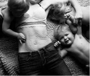 最好的预防妊娠纹的油,妊娠纹长后还能抹油消除吗