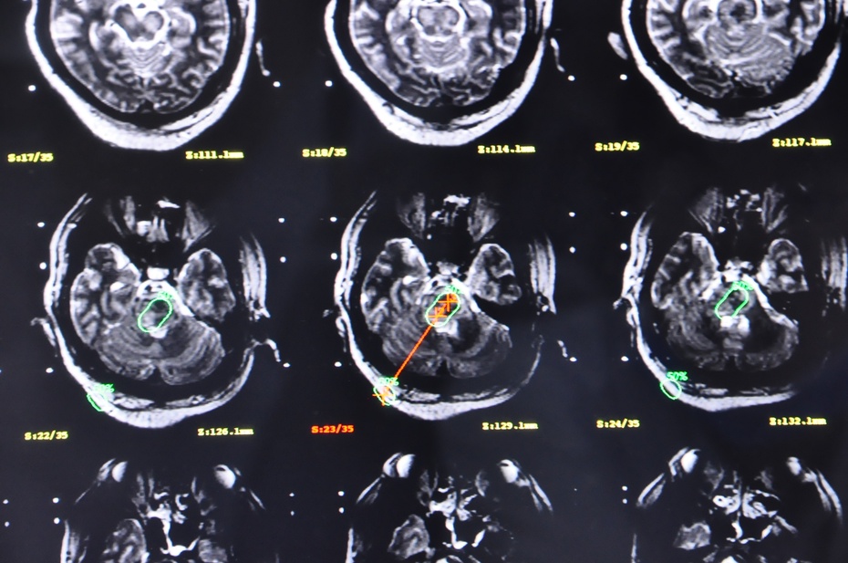 立体定向脑干血肿清除术,脑干血肿清除术
