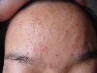 痘印变黑一直不消怎么办,痘印变黑后怎么消除