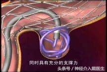脑血管畸形介入手术是放支架吗,脑部血管支架介入手术风险大吗