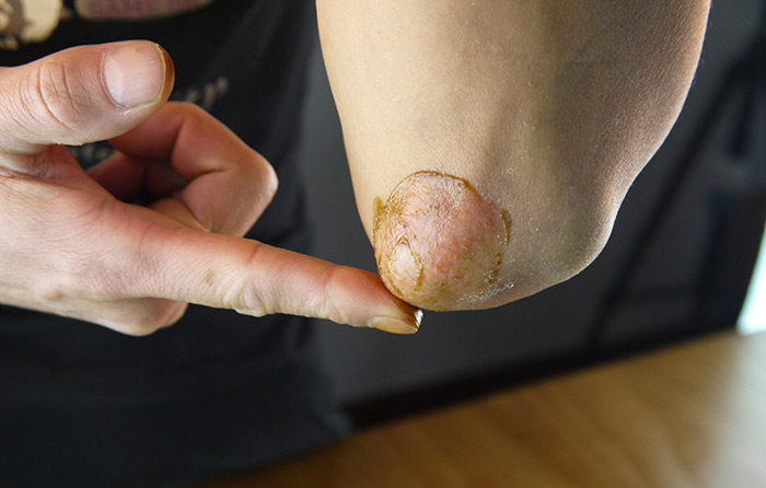 春天湿疹中医治疗法,春季湿疹中药调理