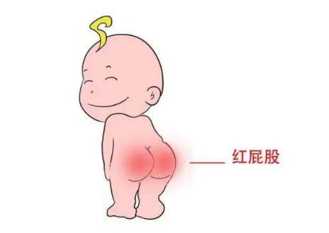 宝宝尿布疹的原因及护理方法,妈妈换尿布发现宝宝屁股红