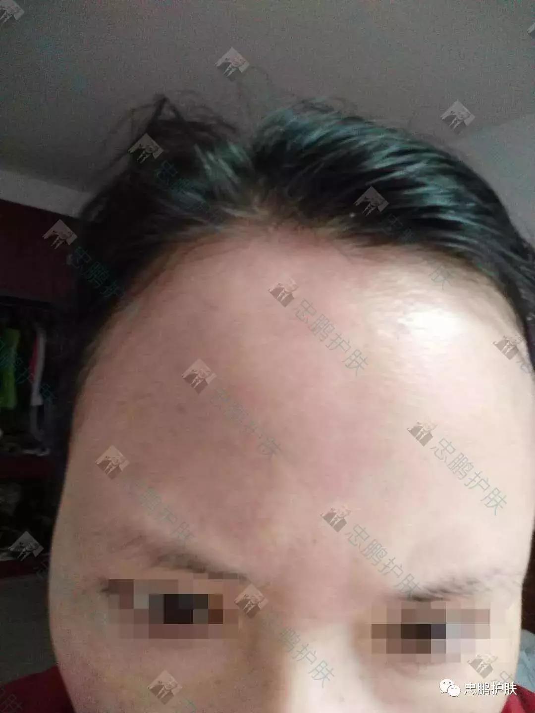 激素脸发红发热脱皮怎么办呢,激素脸为什么会扩散到脖子上代谢