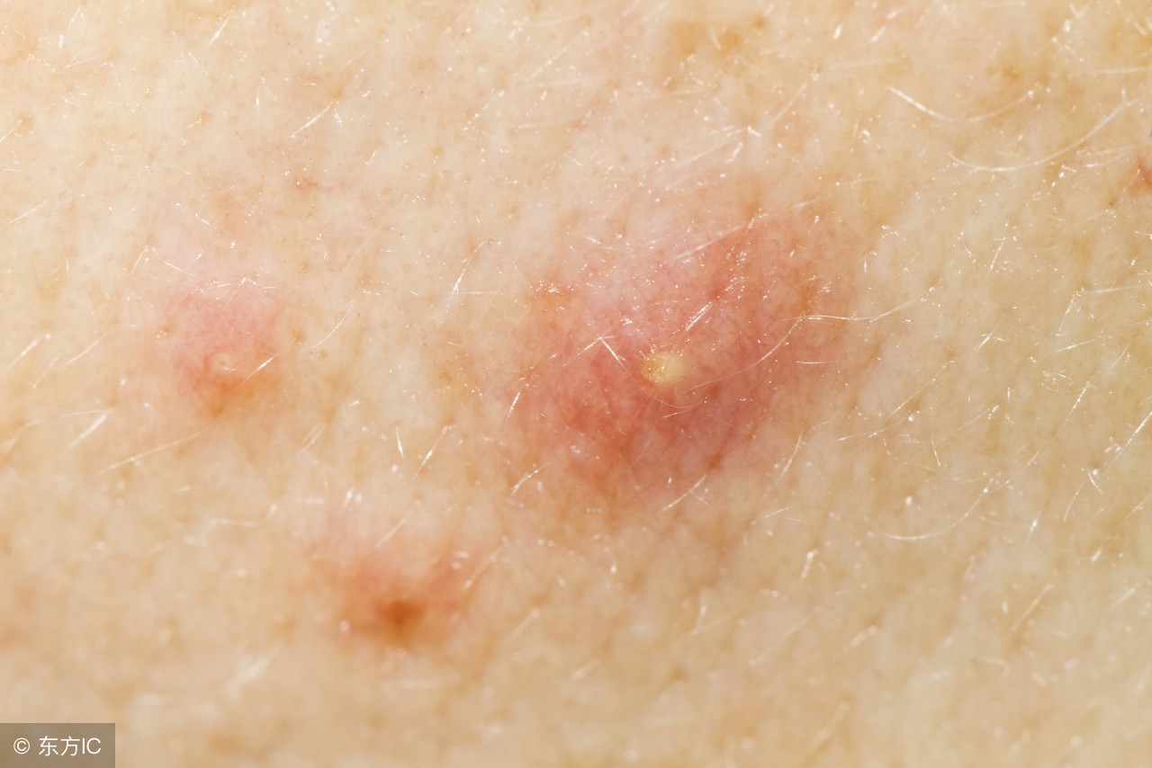 深扒：“非皂基”硫磺皂68元还都用？硫磺皂到底能不能用来洁面？