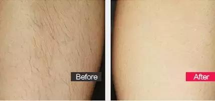 一秒脱毛,如何在一分钟内脱毛