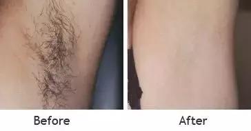 一秒脱毛,如何在一分钟内脱毛