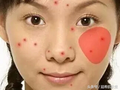 35岁女性脸上反复长痘痘怎么调理,下巴长满痘痘是什么原因怎么调理