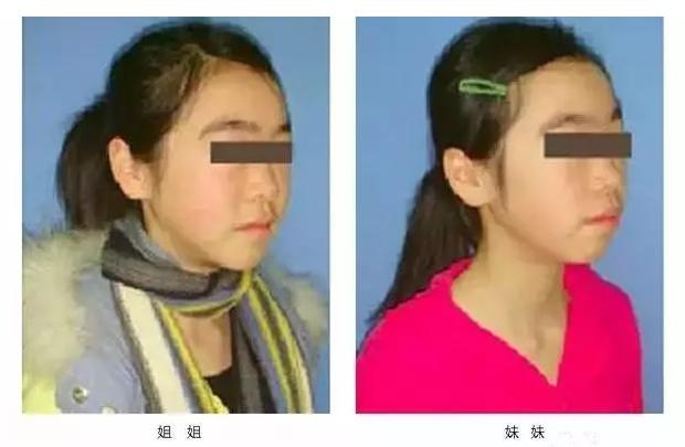 双胞胎连牙齿都一模一样,双胞胎牙齿拥挤错位