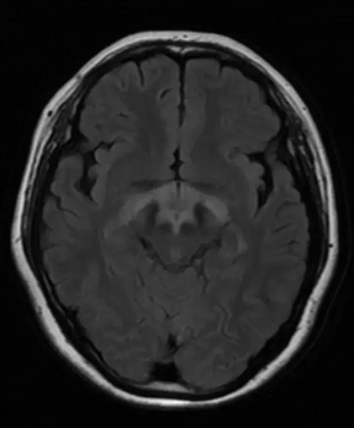 复旦大学附属中山医院放射科病例讨论（八十四）