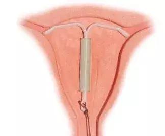 产后上环对哺乳宝宝有啥影响,产后多久可以上环最合适