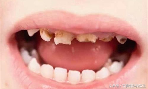 龋齿原因及防治方法,小儿龋齿的原因及防治措施