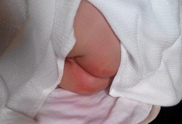 宝宝屁股有尿布疹怎么治疗,湿疹引起的尿布疹