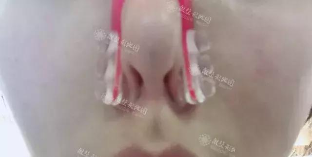 整形“神器”大测评：传说中的隆鼻夹真的靠谱吗？