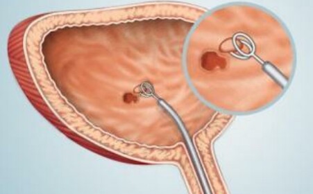 不知道这些，你就不知道膀胱癌是怎么治疗的？