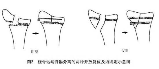 儿童骨骺受损后果严重吗,儿童损伤导致骨骺线闭合