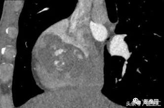 少见原发性心脏肿瘤