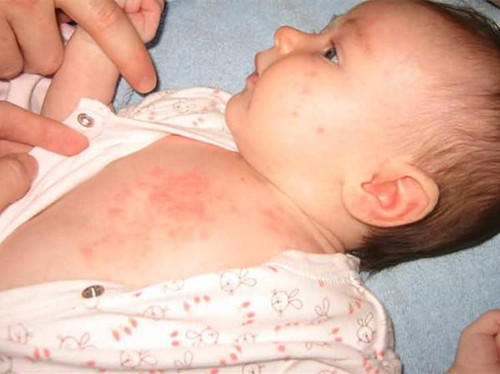 为什么宝宝湿疹总不好?多是家长了犯了这5类错!