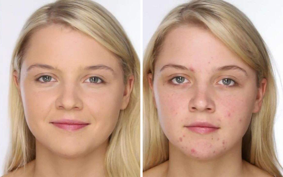 后背出油、长痘?一招教你解决!