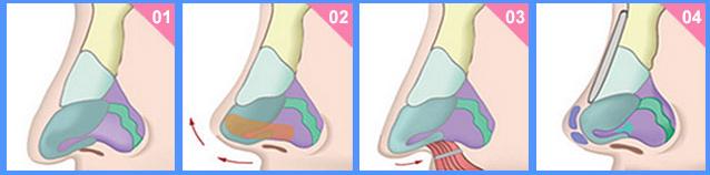 欧式鼻梁,欧美型隆鼻