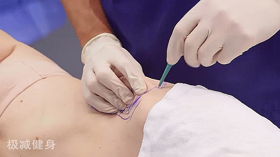 减肥抽脂的过程是怎样的,抽脂减肥的危害亲身经历