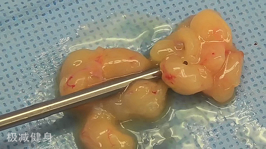 抽脂减肥的五大误区,减肥抽脂的过程是怎样的