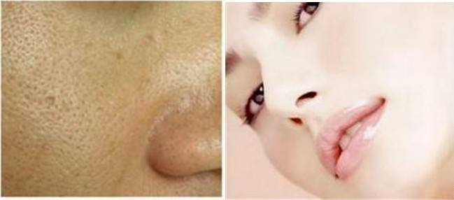 消除毛孔粗大方法,毛孔粗大收缩毛孔的几种方法