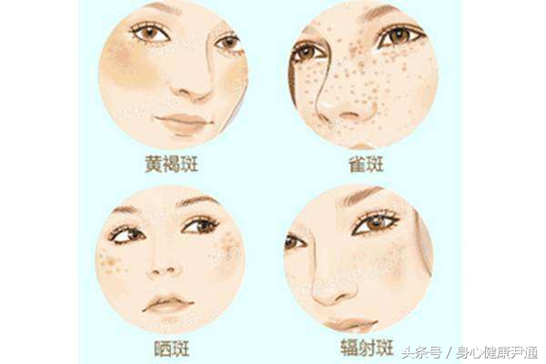 「案例分享」*褐斑黄**、失眠多梦、痛经——血府逐瘀汤