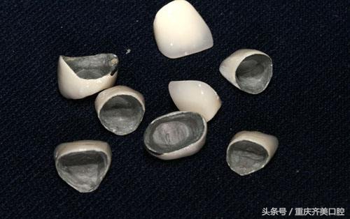 你的烤瓷牙大面积崩瓷了吗？如何处理崩裂的烤瓷牙？