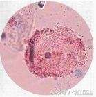 瀛曟湡鏌ュ嚭姊呮瘨鑰佸叕浼氫粙鎰忓悧,瀛曟湡缁嗚弻鎬ч槾閬撶値鐥囩姸